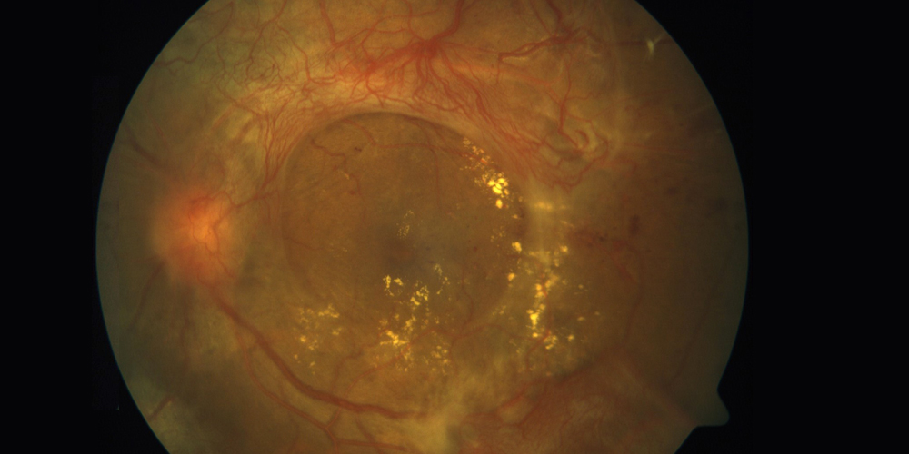 Diabetic Retinopathy (DR): Symptoms and Treatment