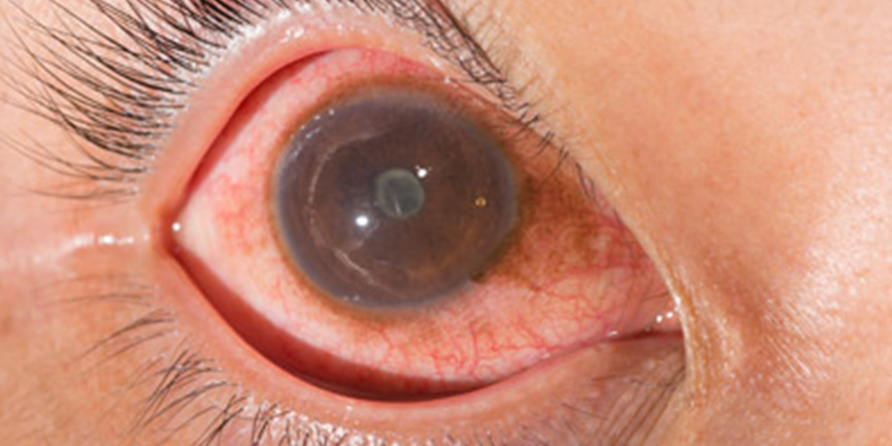 Symptoms, Causes and Treatment of Uveitis