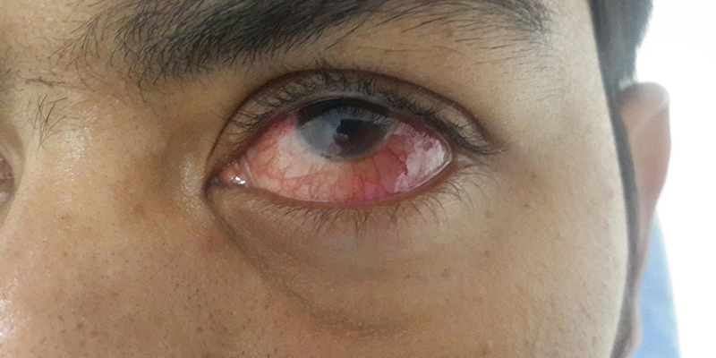 Ocular Tuberculosis Part 1