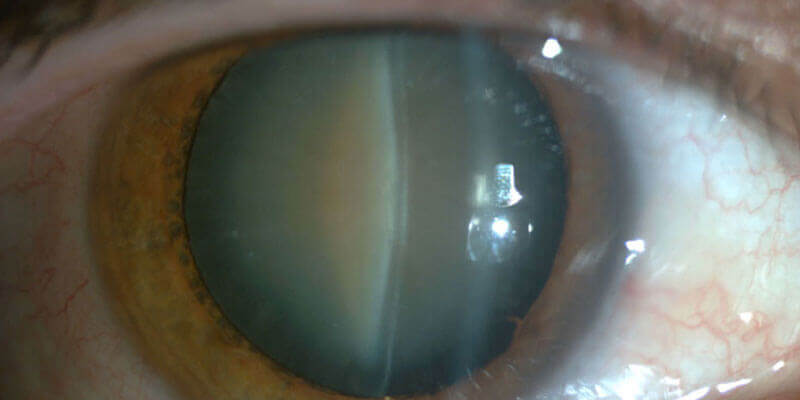 cataract-treatment