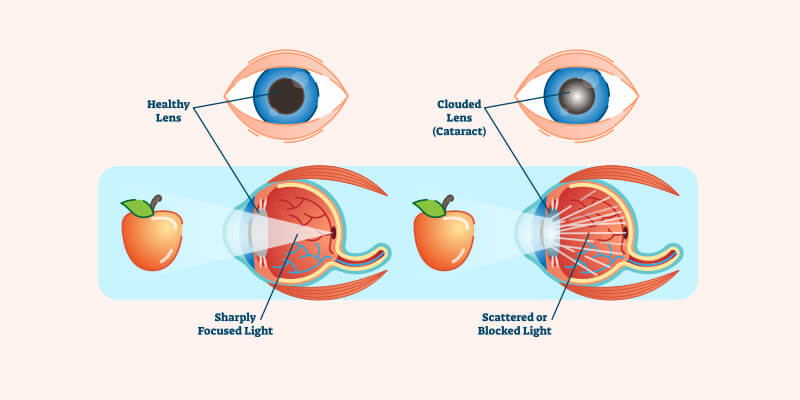 Cataract