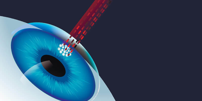 laser-eye-treatment