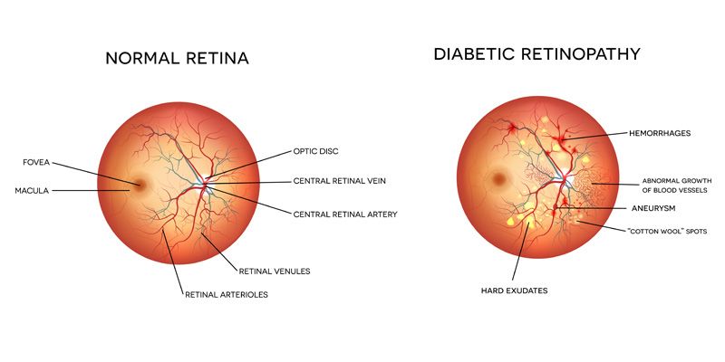 diabetic-retinopathy