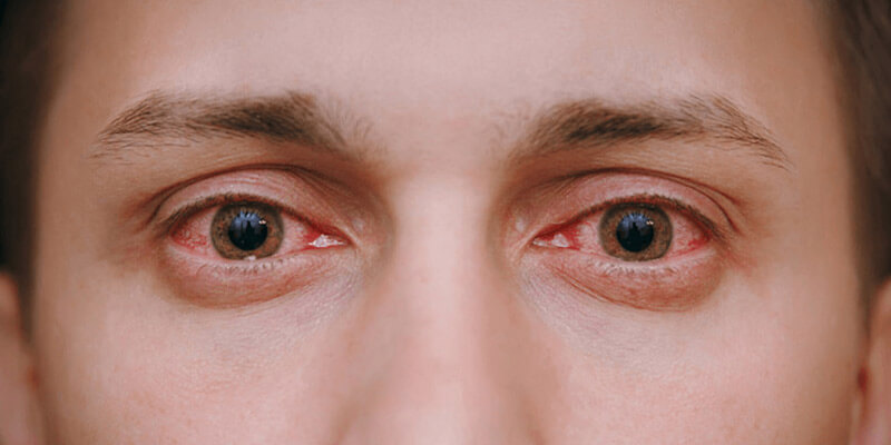 Eye Problems