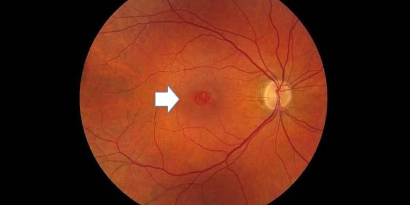 Macular Hole