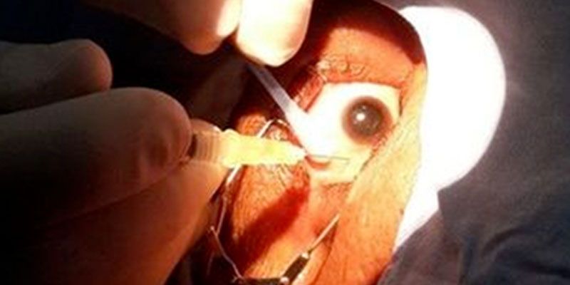 Cystoid-macular-oedema