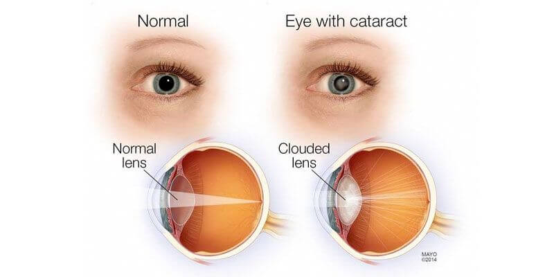 Debunking the Myths around Cataract