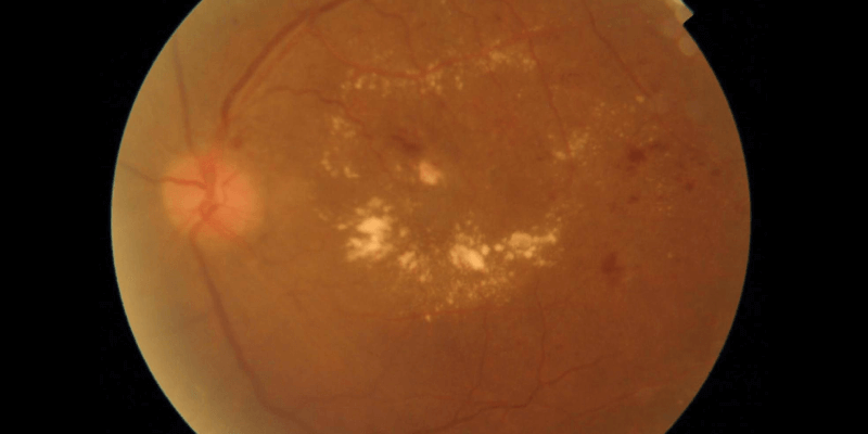 Diabetic-Macular-Oedema
