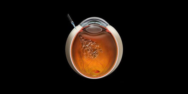 Intravitreal Injections