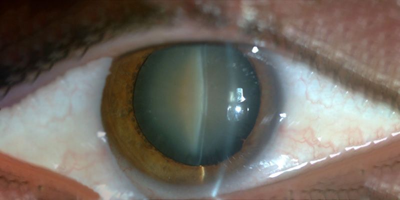 Post-Operative Care After Cataract Surgery