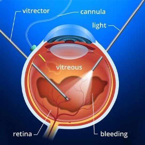Vitrectomy Surgery Strategies ＆Tactics Vitrectomy Surgery - Meadows Eye Physicians & Surgeons