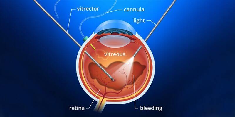 Vitrectomy Surgery Strategies ＆Tactics Guide to Vitrectomy: Costs, Timelines & More – NVISION