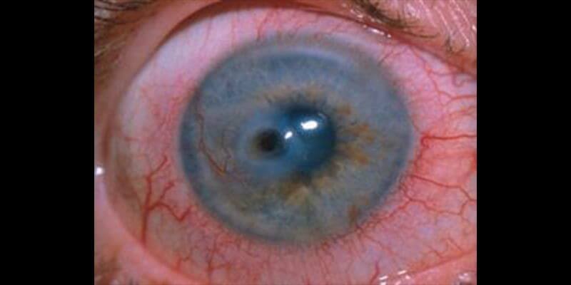 Common Symptoms of Corneal Diseases
