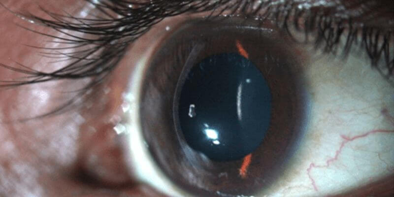 Keratoconus Screening
