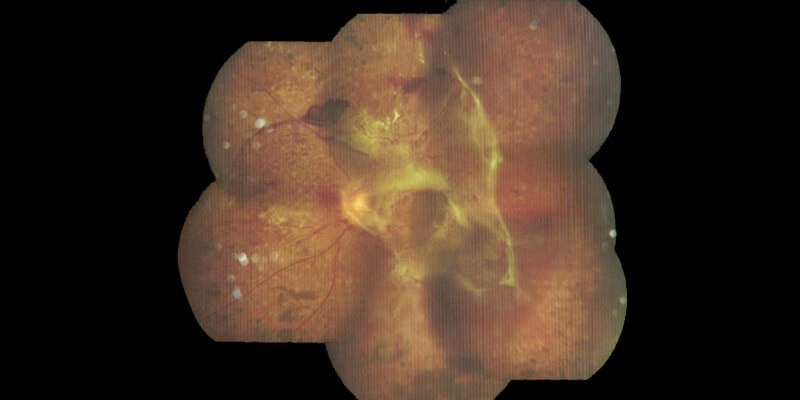 Diabetic Vitrectomy