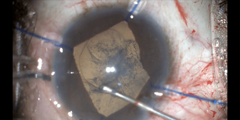 Complicated Cataract
