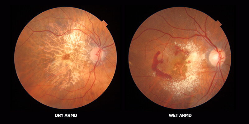 Age Related Macular Degeneration