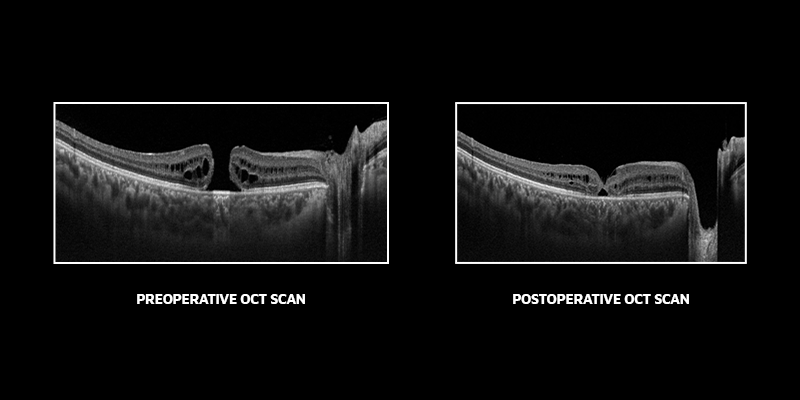 macular hole, macular treatment