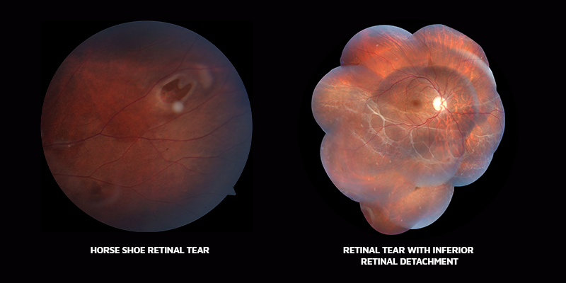 Retinal tear, Horseshoe tear, PVD, Retinal diseases