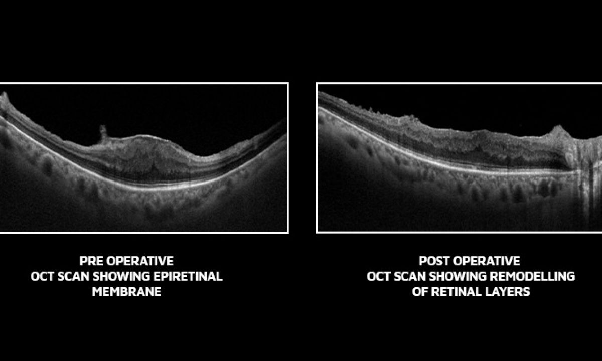 Epiretinal Membrane Icd 10