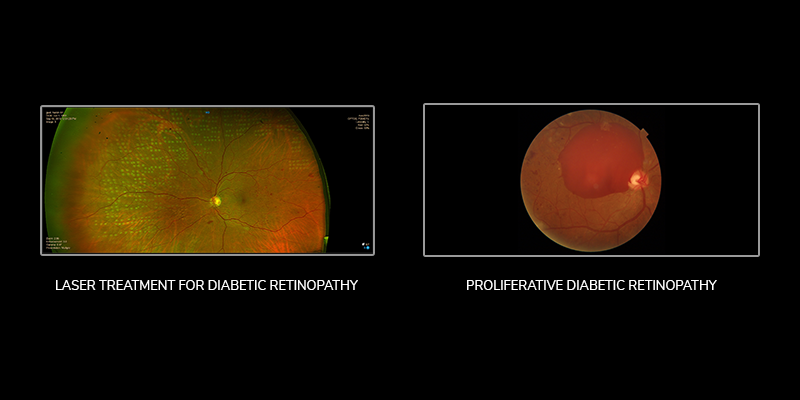 Diabetic-Retinopathy