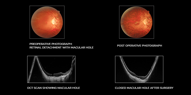 Retinal Detachment: Symptoms, Causes, and Treatment