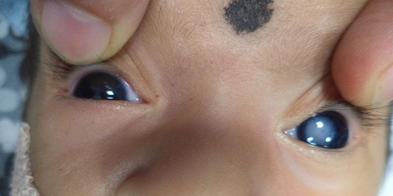 Congenital Cataracts