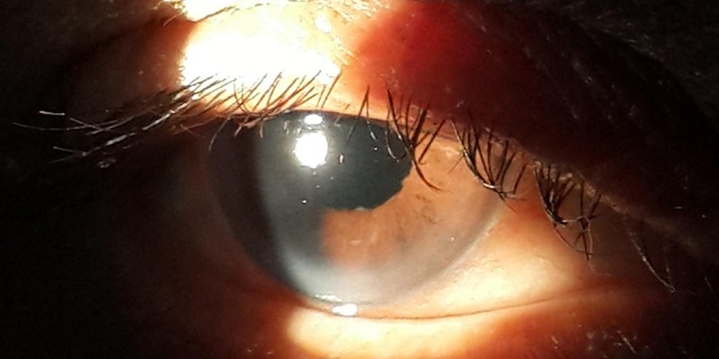 Postoperative picture after implantation of intraocular lens