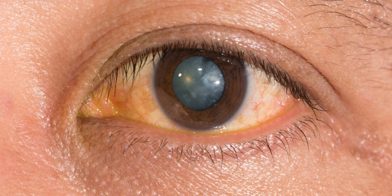 Nuclear-Cataracts