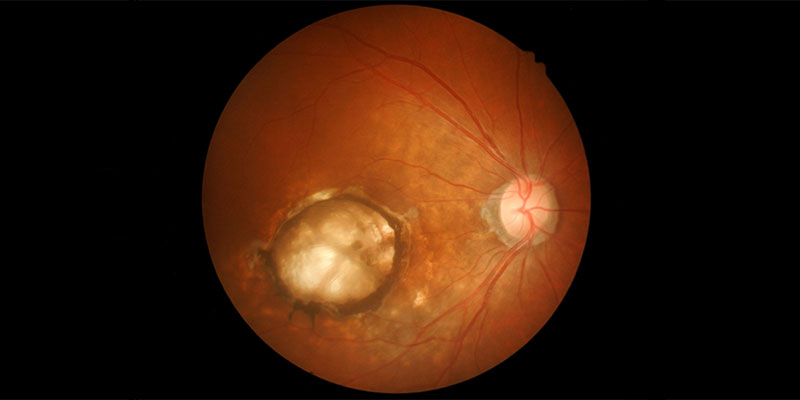 Retinal-Hole-and-Retina-Break