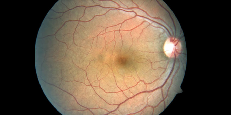 Leptospiral-Uveitis