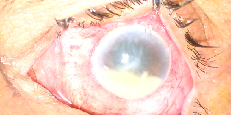 Endophthalmitis
