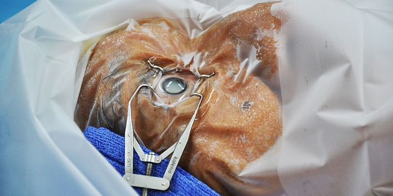 cataract surgery, COVID-19