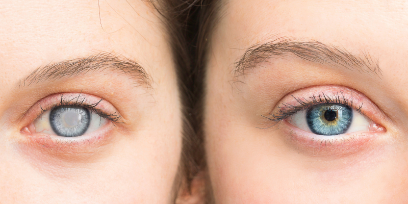 New Developments in  Cataract Surgery and Treatment