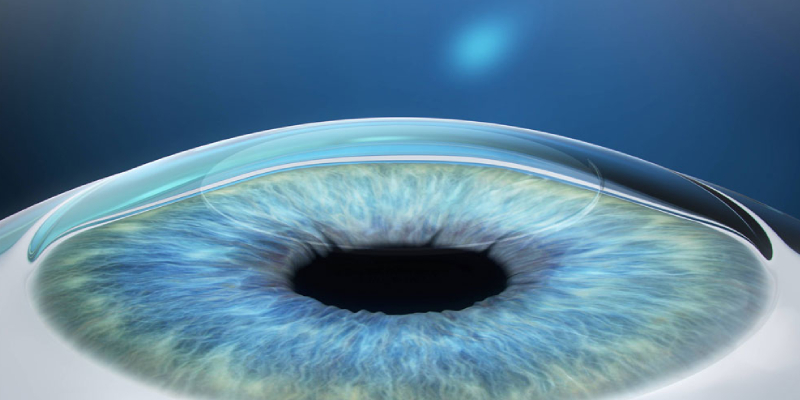 Lasik eye surgery