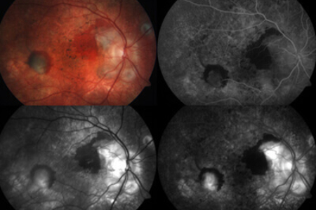 retinal-care