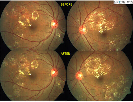 Focul laser