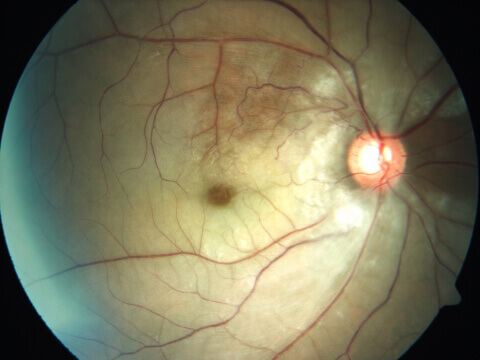 Fundus picture