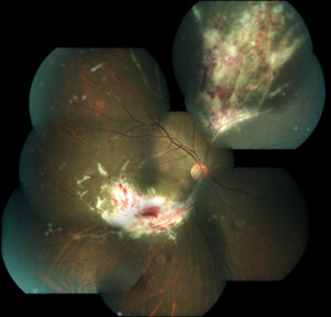 CMV retinitis