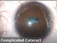 Complicated cataract