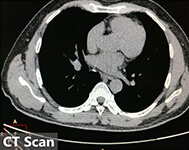 CT scan