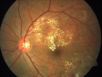 Diabetic Maculopathy