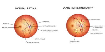 Diabetic Rethonopaty