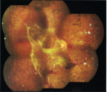 Diabetic tractional