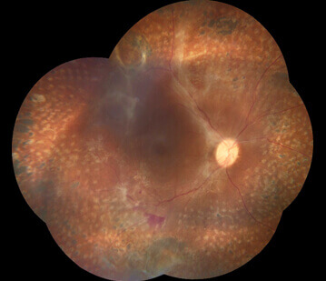 Diabetic tractional