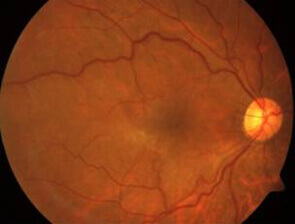 epiretinal membrane