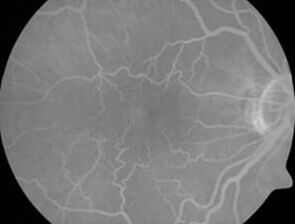 epiretinal-membrane
