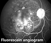 fluorescein-angiogram-uvea
