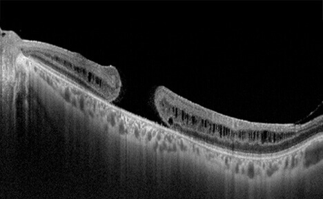 Macular Hole