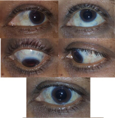 fungal nodular scleritis after